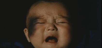 A tight closeup photo of a crying baby, with the right side of its face disfigured by a dark discoloration